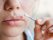 A partir de quand un bouton de fièvre n’est plus contagieux?