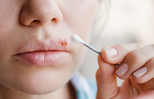 A partir de quand un bouton de fièvre n’est plus contagieux?