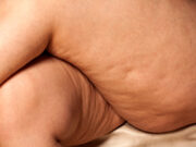 Nos conseils pour éliminer la cellulite