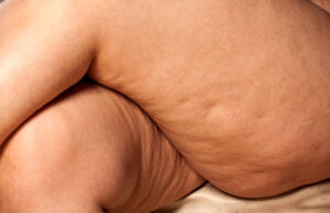 Nos conseils pour éliminer la cellulite