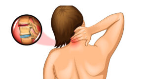Névralgie cervico-brachiale et cancer : Y a t-il un lien ?