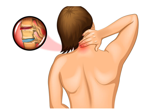 Névralgie cervico-brachiale et cancer : Y a t-il un lien ?