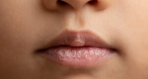 4 astuces pour éviter les gerçures en hiver