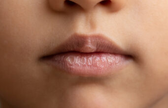 4 astuces pour éviter les gerçures en hiver