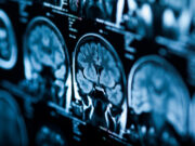 Tumeur au cerveau : attention si vous souffrez de ces symptômes