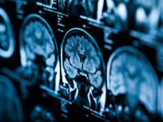 Tumeur au cerveau : attention si vous souffrez de ces symptômes
