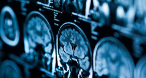 Tumeur au cerveau : attention si vous souffrez de ces symptômes
