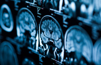 Tumeur au cerveau : attention si vous souffrez de ces symptômes