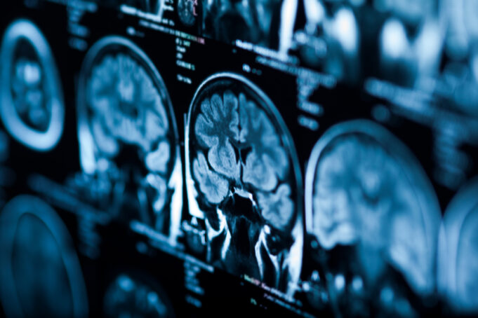 Tumeur au cerveau : attention si vous souffrez de ces symptômes