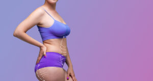 Chirurgie esthétique : la liposuccion en tête