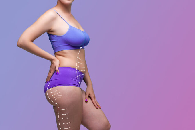 Chirurgie esthétique : la liposuccion en tête