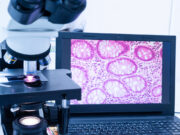 Première mondiale : une intelligence artificielle dans le diagnostic du cancer du sein