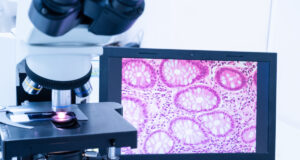 Première mondiale : une intelligence artificielle dans le diagnostic du cancer du sein