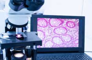 Première mondiale : une intelligence artificielle dans le diagnostic du cancer du sein