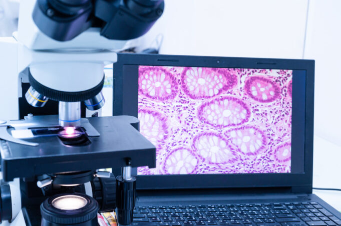 Première mondiale : une intelligence artificielle dans le diagnostic du cancer du sein