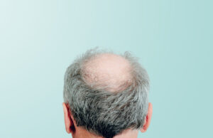 Les boissons sucrées peuvent vous faire perdre vos cheveux