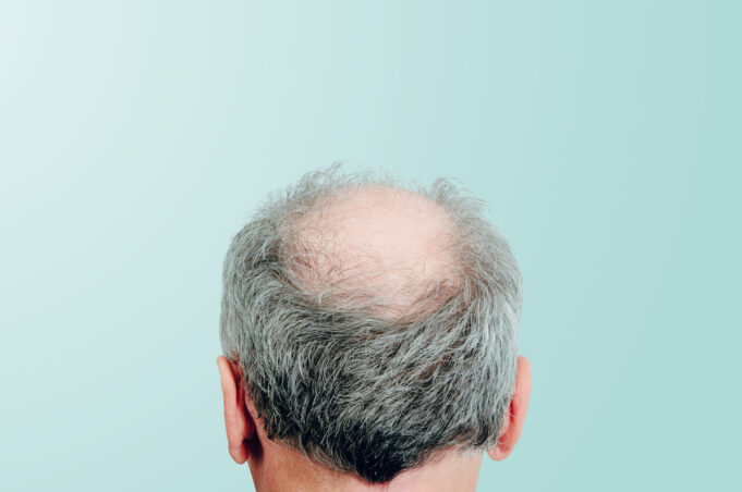 Les boissons sucrées peuvent vous faire perdre vos cheveux