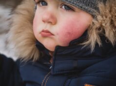 Comment éviter l’urticaire au froid ?