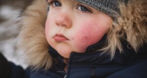 Comment éviter l’urticaire au froid ?