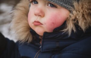 Comment éviter l’urticaire au froid ?