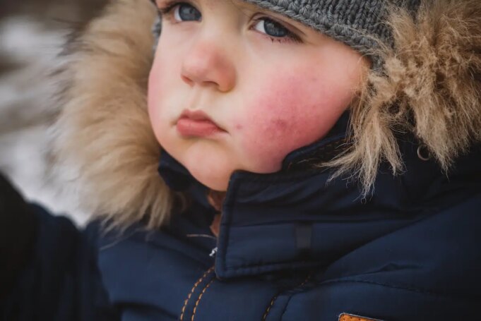 Comment éviter l’urticaire au froid ?
