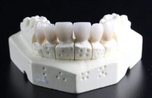 Quels sont les les avantages et les risques des aligneurs dentaires en France ?