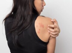 La covid provoque-t-elle de l’urticaire ?
