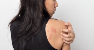 La covid provoque-t-elle de l’urticaire ?