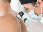 Quels sont les premiers signes d’un cancer de la peau ?