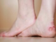 Faut il percer une ampoule ?