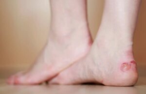 Faut il percer une ampoule ?