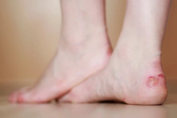 Faut il percer une ampoule ?