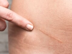 Comment soigner et effacer une cicatrice ?