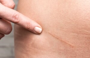 Comment soigner et effacer une cicatrice ?