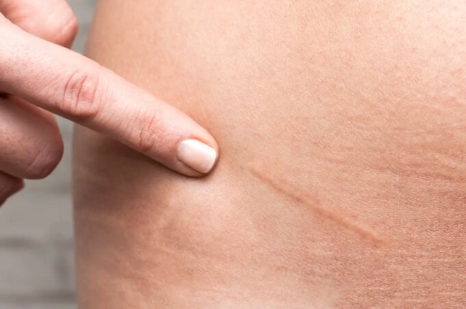 Comment soigner et effacer une cicatrice ?