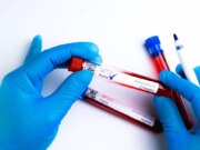 Variole du singe : une forme mortelle identifiée chez certains patients