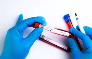 Variole du singe : une forme mortelle identifiée chez certains patients