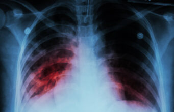 Quelle est cette maladie grave qui n’a pas disparue de France ?