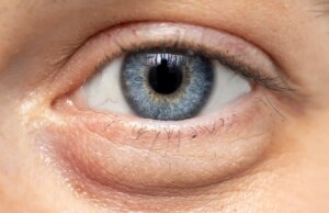 Poches sous les yeux : comment s’en débarrasser ?