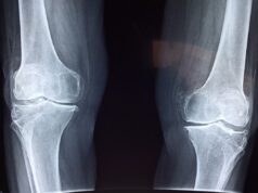 Ces 5 signes qui montrent que vous avez les os fragiles