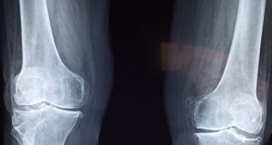Ces 5 signes qui montrent que vous avez les os fragiles
