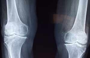 Ces 5 signes qui montrent que vous avez les os fragiles