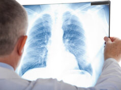 Cancer des poumons : en serez-vous victime dans 10 ans ?
