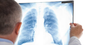 Cancer des poumons : en serez-vous victime dans 10 ans ?