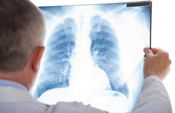 Cancer des poumons : en serez-vous victime dans 10 ans ?