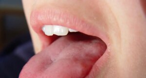 Cancer de la langue : ces signes à ne pas négliger