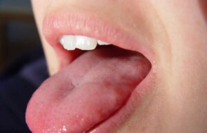 Cancer de la langue : ces signes à ne pas négliger