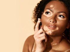 Peau : un traitement prometteur contre le vitiligo