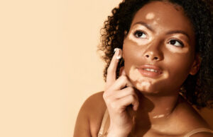 Peau : un traitement prometteur contre le vitiligo