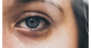 Pourquoi a-t-on des cernes quand on est fatigué ?